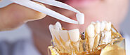 7 Tips for Faster Dental Implant Recovery