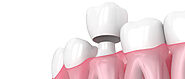 Seven Problems You Can Fix with a Dental Crown