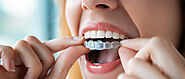 Invisalign vs. Braces: Which One Is Right for You