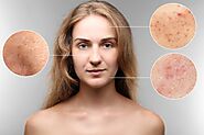 Unani Medicine for Pimples - Get Rid of Acne Fast Using Unani Medicine - Ajmal Dawakhana