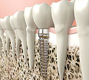 Dental Implants Near You