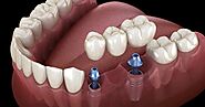 Know-How Dental Implants are So Trending