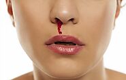 Home Remedy for Nose Bleed - How to Stop Nose Bleeding Forever