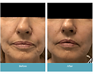 PDO thread lifting of the jowls - New Skin Laser Center