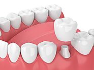 What are the Pros and Cons of Dental Crowns? - Hello Smile Dental