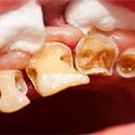 Wisdom Teeth Removal - A Corrective Measure to Reduce the Pain Fast