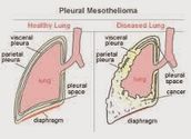 Mesothelioma Cases - USA Mesothelioma Attorney Lawyer And Firms List