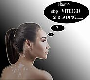 How to stop Vitiligo Spreading ? How to control Vitiligo Spreading ?
