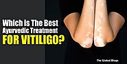 The best Ayurvedic treatment for Vitiligo