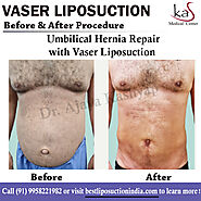 Best Vaser Liposuction Procedure in Delhi