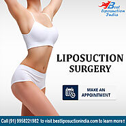 Liposuction Surgery in Delhi India - KAS Medical Center