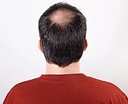 Best Hair Transplant in Delhi At Dadu Medical Centre | Dr Nivedita Dadu