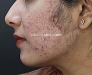 Acne Treatment in Delhi At Dadu Medical Centre