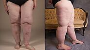 Lipedema?