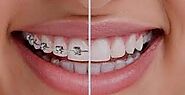 Orthodontic Options – What Are Your Choices? – Site Title