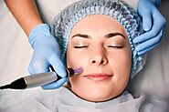 Micro-Needling, The New Way to Treat the Skin's Lines, Wrinkles and Scars, Normally