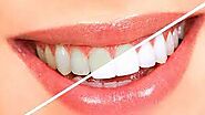 Best Teeth Whitening in Dubai, Abu Dhabi & Sharjah | Zoom & Laser Tooth Cost