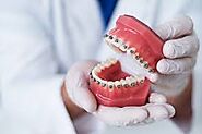 Dental Braces in Dubai & Abu Dhabi - Teeth Braces | Metal & Ceramic Cost