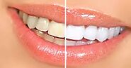 Zoom Teeth Whitening in Dubai UAE & Abu Dhabi | Laser Tooth Whiten Cost