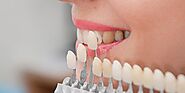 Dental Veneers Cost in Dubai