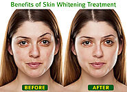 What are the skin whitening treatments benefits?