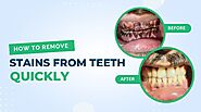 How to Remove Stains From Teeth Quickly? | Teethcare
