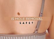 Is Mole Removal Safe? | Truly Permanent Beauty