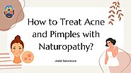 How to Treat Acne and Pimples with Naturopathy? – Jindal Naturecure