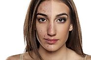 Acne Treatment In Delhi From Skin Expert