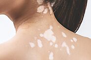 Vitiligo Specialist in Delhi | Best White Patches/Vitiligo Treatment in Delhi