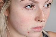 Myths and Facts on Acne by Dr. Rohit Batra – BEST DERMATOLOGIST IN DELHI