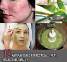 12 Effective Natural Cures for Rosacea - Treat Rosacea Naturally