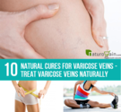 10 Effective Natural Cures for Varicose Veins - Treat Varicose Veins Naturally