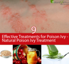 Natural Poison Ivy Treatment - 9 Effective Treatments for Poison Ivy