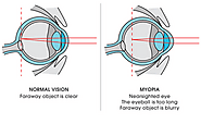 LASIK Surgery | Best LASIK treatment, doctor & hospital | Delhi