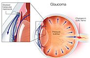 Glaucoma Surgery | Glaucoma treatment | Kala-motia treatment | Delhi