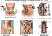 A Way To Treat Cervical Stenosis: Posterior Cervical Discectomy And Fusion