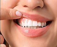 #1 Teeth Whitening Sacramento | Teeth Bleaching Dentist