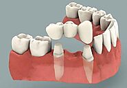 Get Professional Dental Crowns and Bridges Treatment in Melbourne