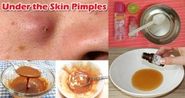 11 Top Home Remedies to Remove Acne Scars