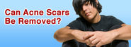 Can Acne Scars Be Removed?