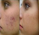 25 Home Remedies For Acne Scars Removal Naturally
