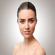 How Pigmentation Treatment Helps to Remove Spots from the Face