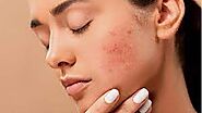 ACNE TREATMENT IN ISLAMABAD
