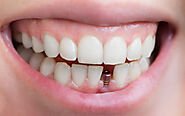 Dental Implants: Traditional Vs. Mini - Westermeier Martin Dental Care