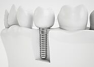 Mini Dental Implants vs. Traditional Implants