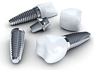 The Difference Between Dental Implants and Mini Dental Implants Irving, TX