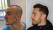 Hair Transplant Clinic in Dubai & Abu Dhabi | Most Advanced FUE Specialist