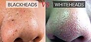 Blackheads Vs. Whiteheads: How Are They Different?