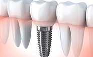 Dental Implants | Dental Implants Clinic in Mumbai